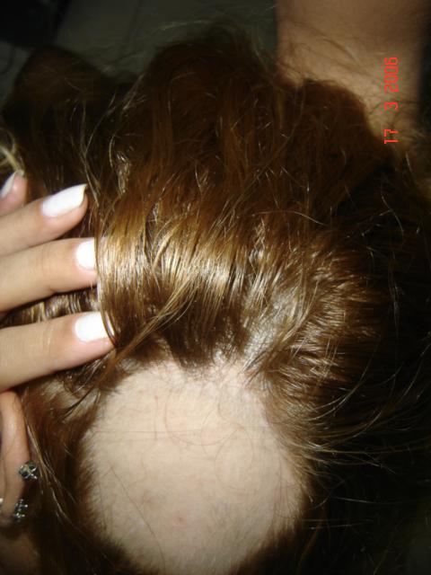 Corte de cabelo 'chavoso' em mulher choca por simular efeitos da calvície